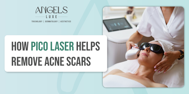 ico-laser-helps-remove-acne-scars