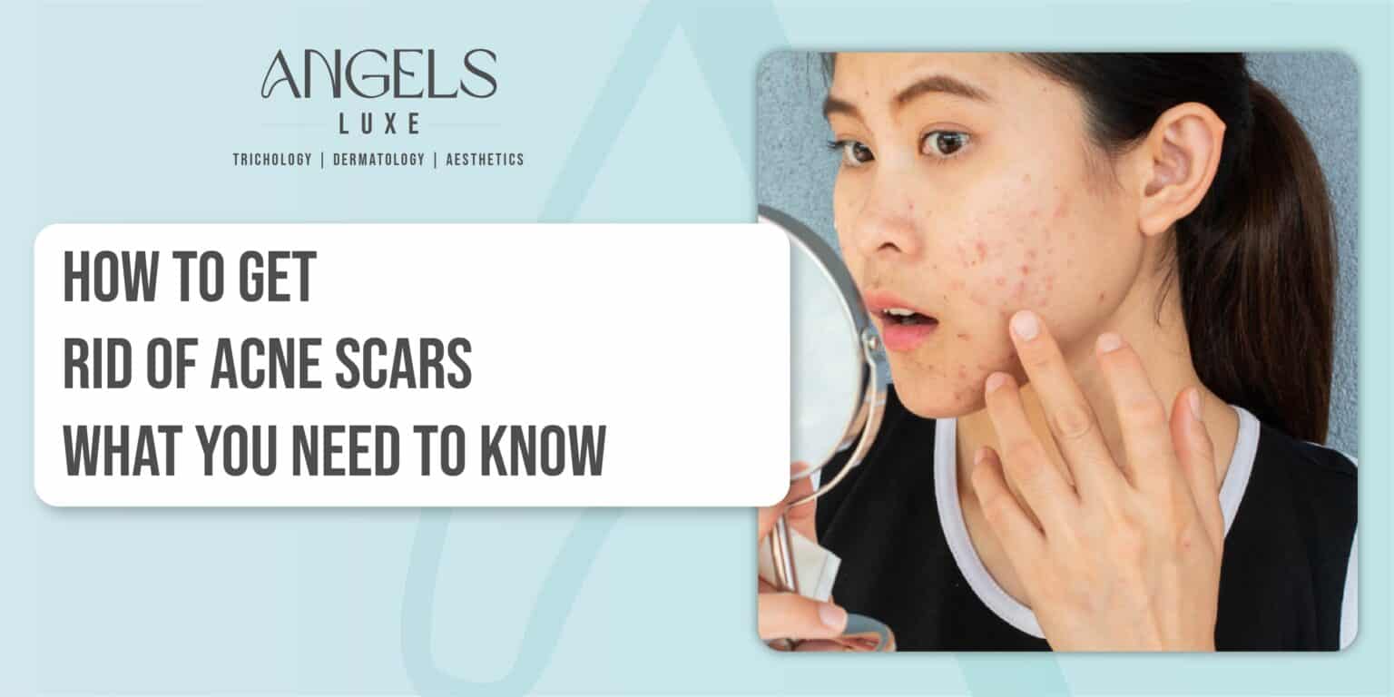 Acne Scar Removal Discover Angels Luxe's Skincare Solutions Angels Luxe
